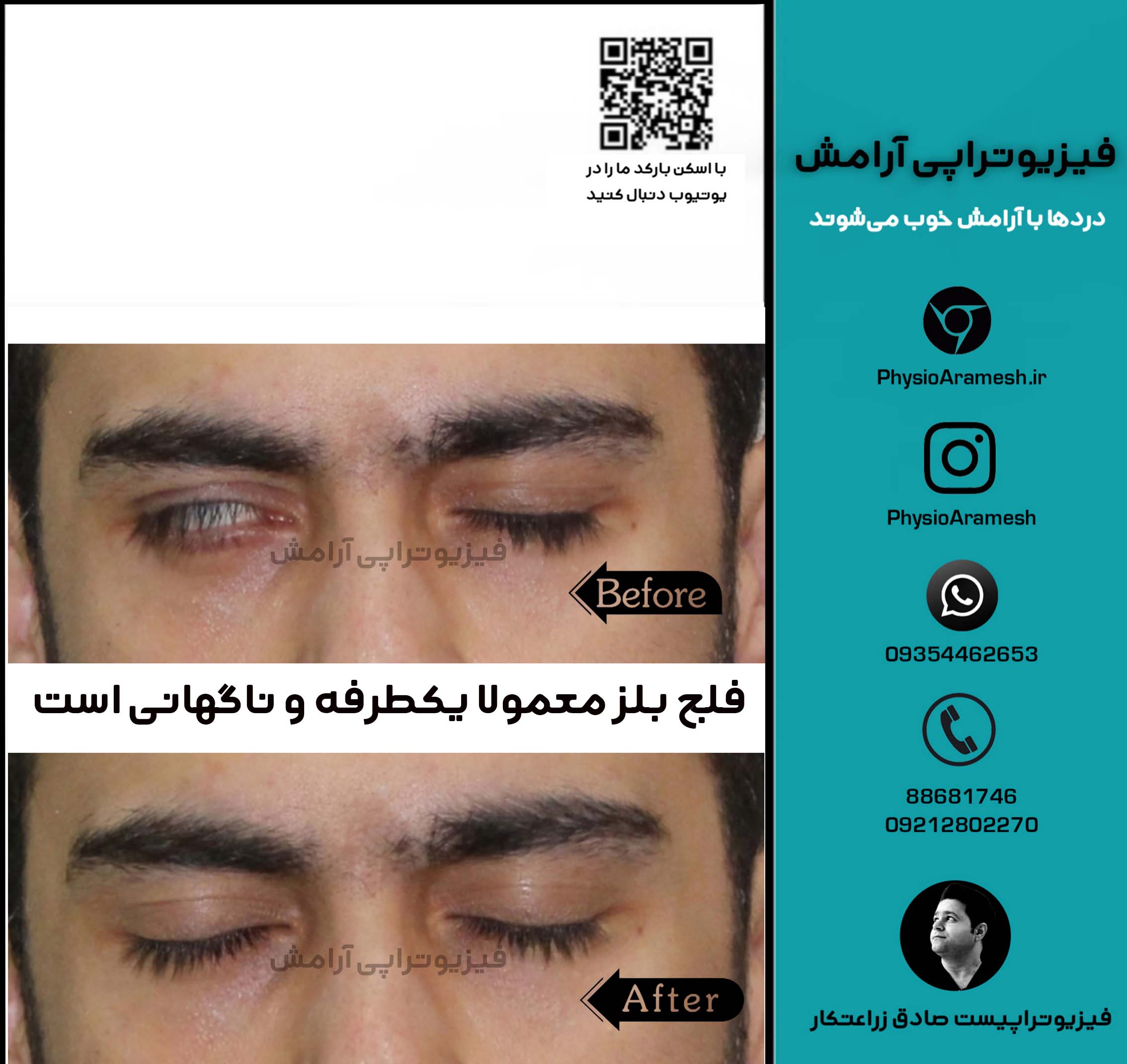 فلج بلز یکطرفه و ناگهانی است